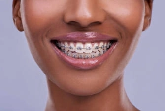 Braces and clear aligners at Summit Dental Care