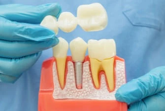 Dental crowns and bridges at Summit Dental Care