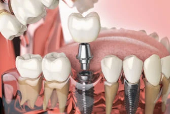 Dental implants at Summit Dental Care
