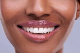 Dental veneers at Summit Dental Care