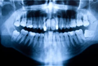 Digital dental X-rays and scans at Summit Dental Care