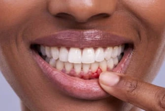 Gum treatment at Summit Dental Care