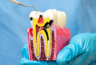 Root canal treatment at Summit Dental Care
