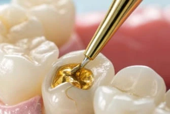 Tooth fillings at Summit Dental Care