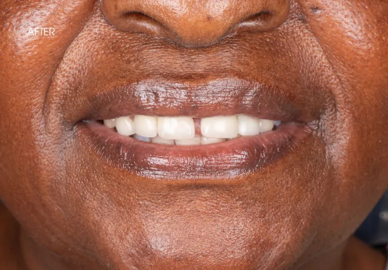 After gap closure at Summit Dental Care