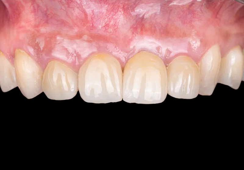 After dental crowns at Summit Dental Care