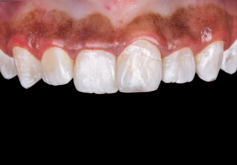 After chipped tooth repair at Summit Dental Care