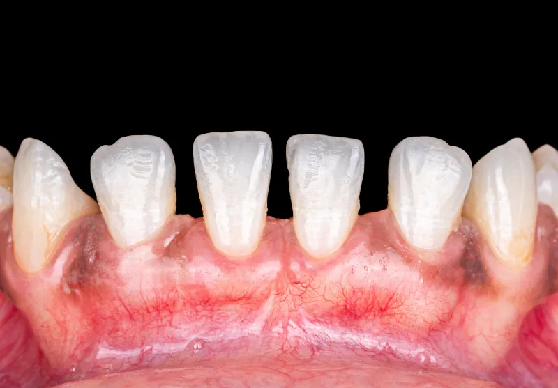 After gum recession treatment at Summit Dental Care
