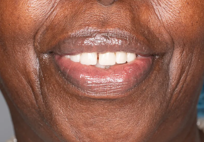 After smile makeover at Summit Dental Care