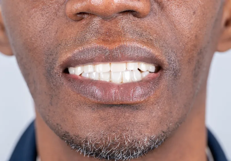 After full smile restoration at Summit Dental Care