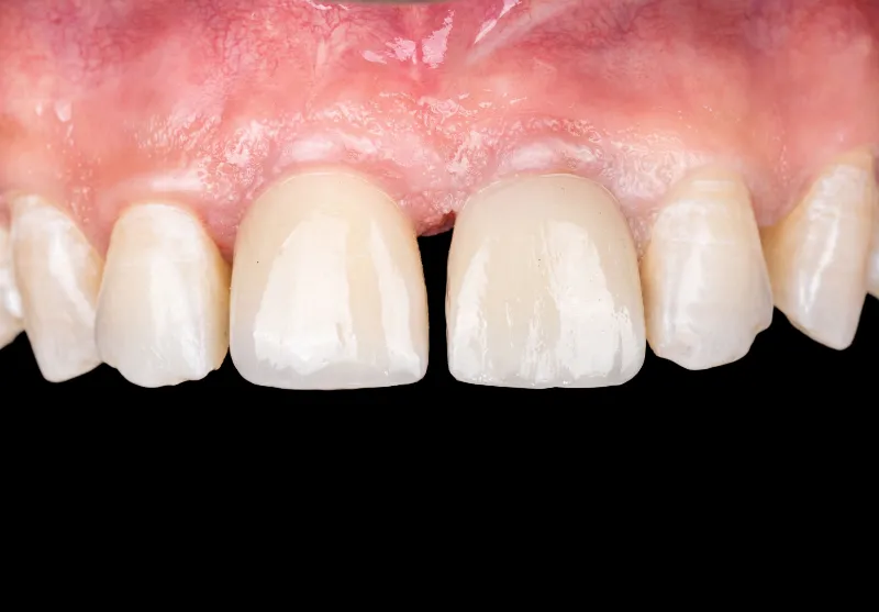 After dental implant crown at Summit Dental Care