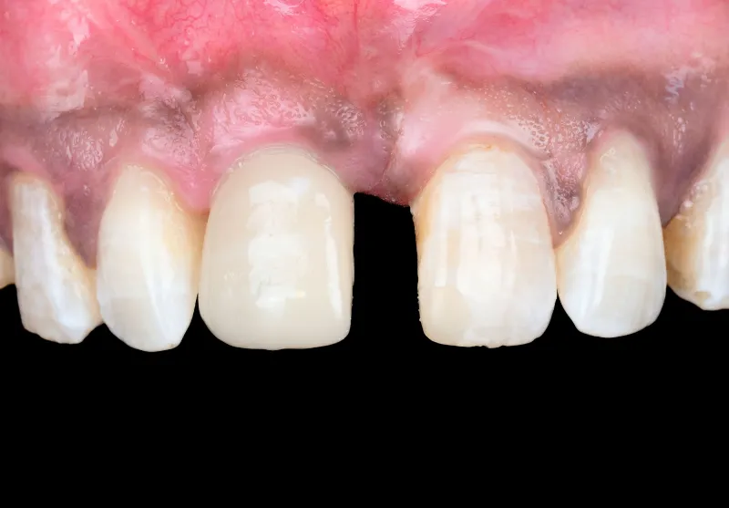 After dental implants at Summit Dental Care