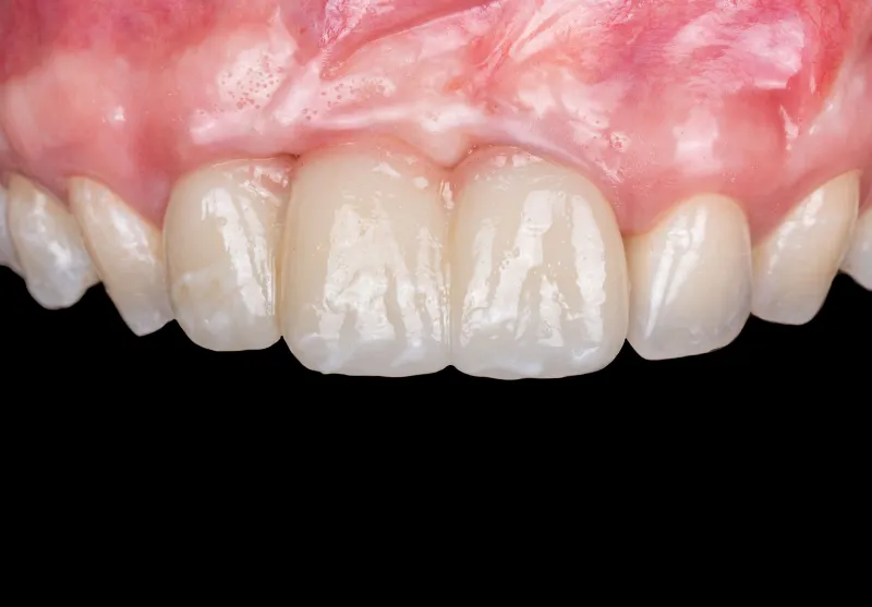 After implant bridge at Summit Dental Care