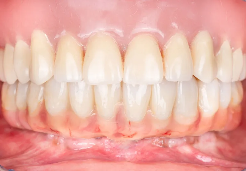 After all-on-4 implants at Summit Dental Care