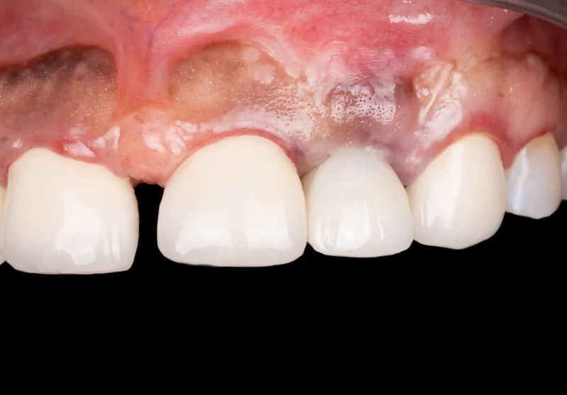After tooth replacement at Summit Dental Care