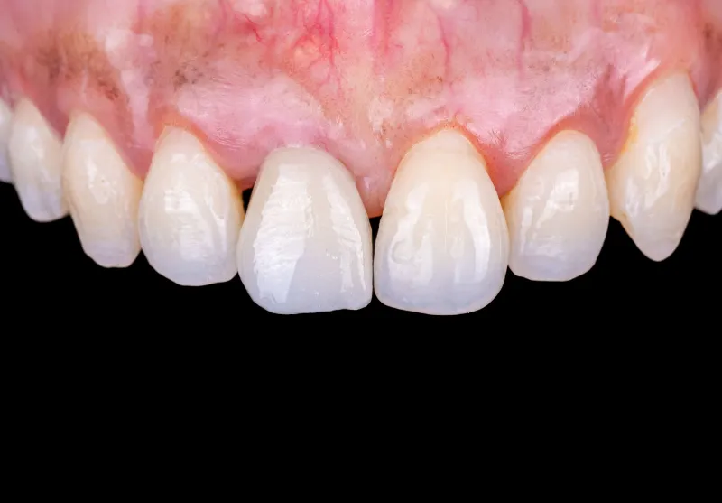 After single tooth implant at Summit Dental Care