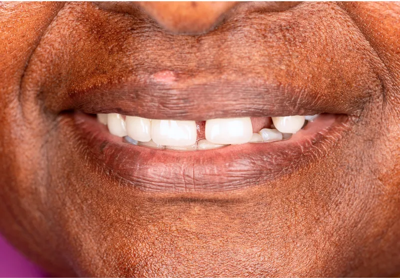 Before gap closure at Summit Dental Care