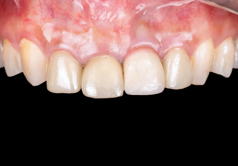 Before dental crowns at Summit Dental Care