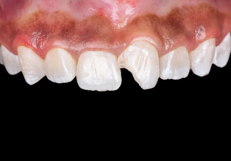 Before chipped tooth repair at Summit Dental Care