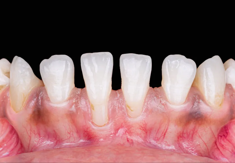 Before gum recession treatment at Summit Dental Care