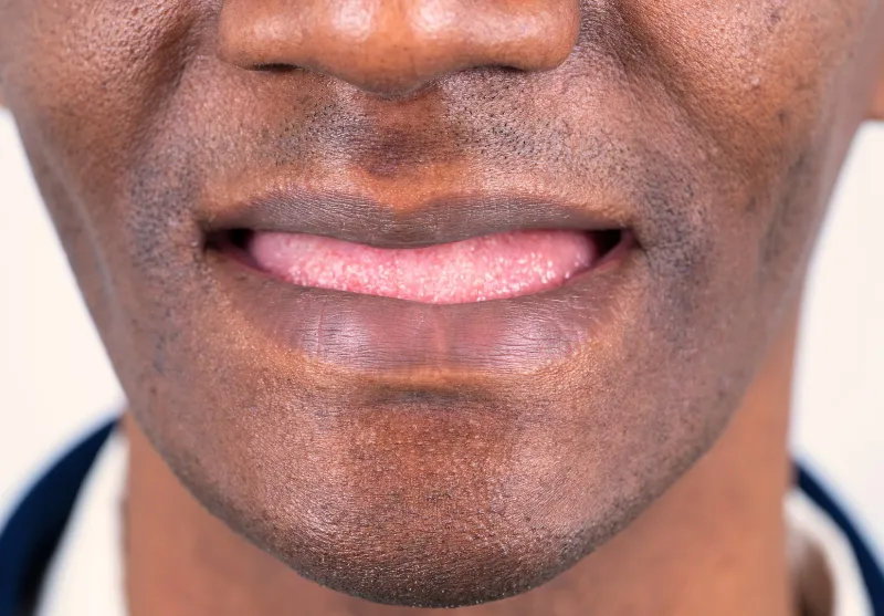 Before full smile restoration at Summit Dental Care