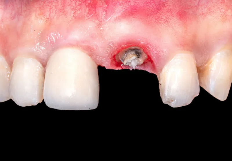Before dental implant crown at Summit Dental Care