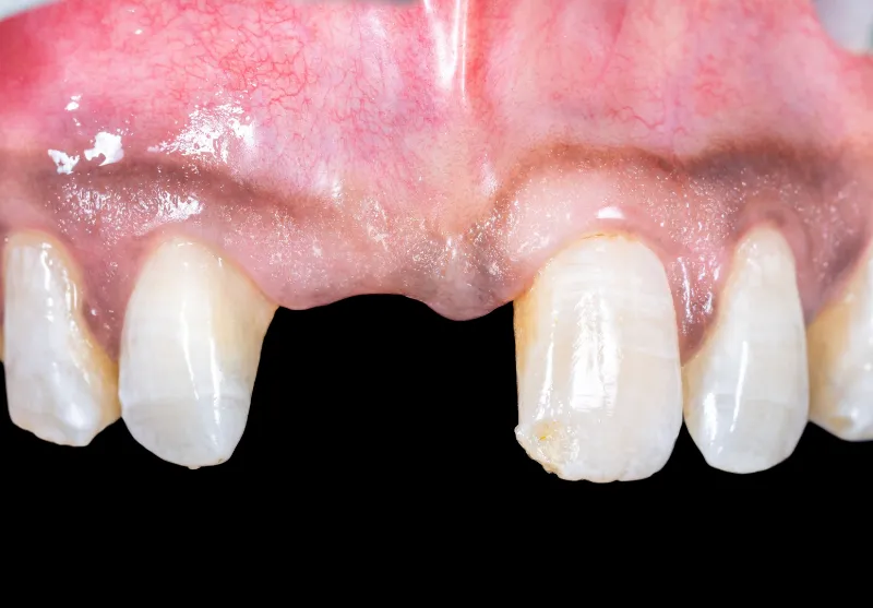 Before dental implants at Summit Dental Care