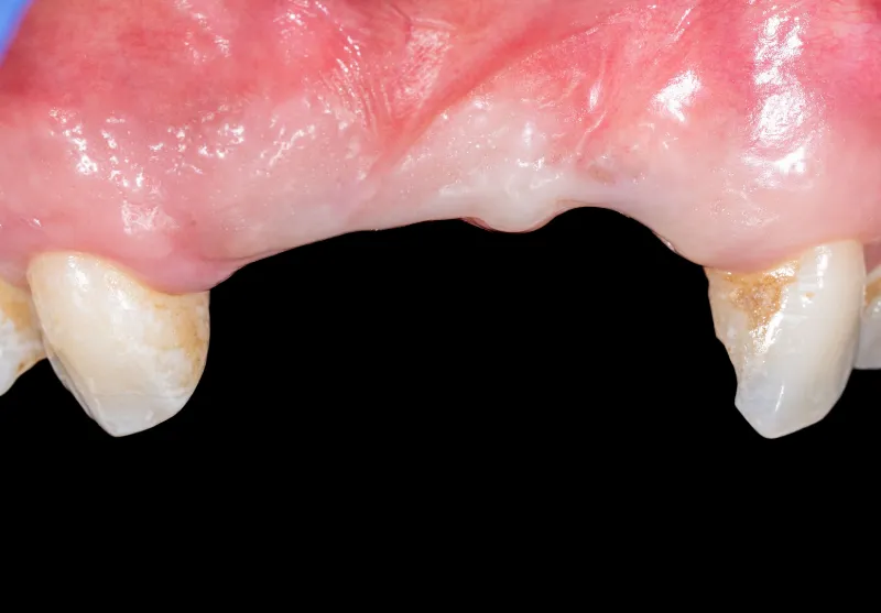 Before implant bridge at Summit Dental Care