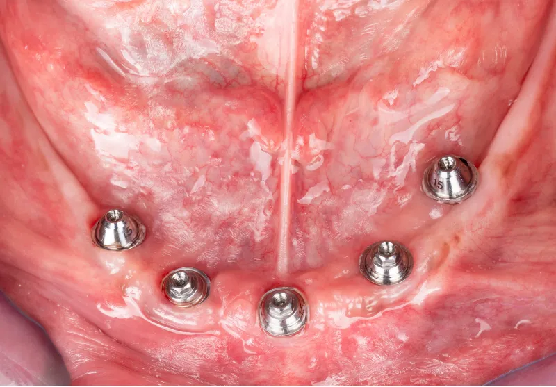 Before all-on-4 implants at Summit Dental Care