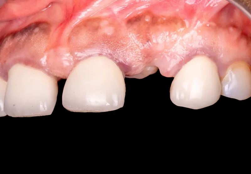 Before tooth replacement at Summit Dental Care