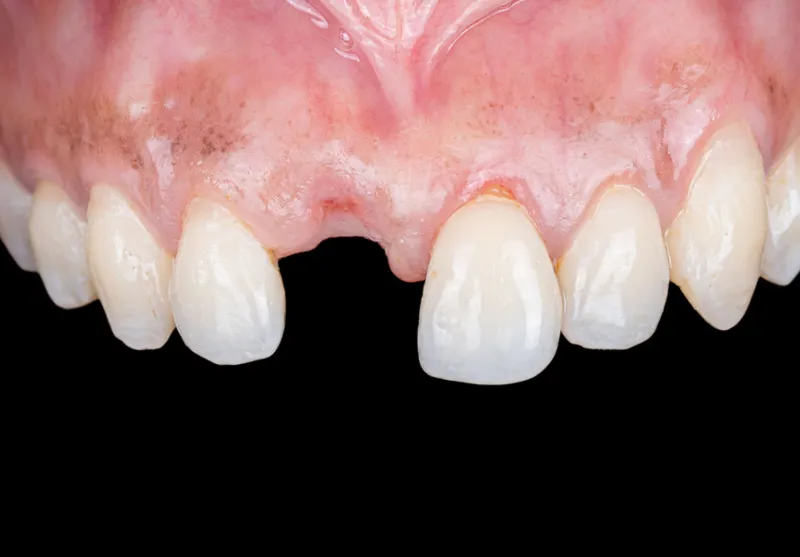 Before single tooth implant at Summit Dental Care